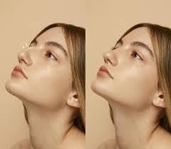 Is a Nose Job in Dubai Right for You
