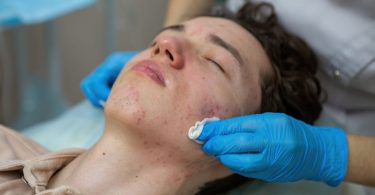 Acne Treatment, Skincare Tips, Clear Skin